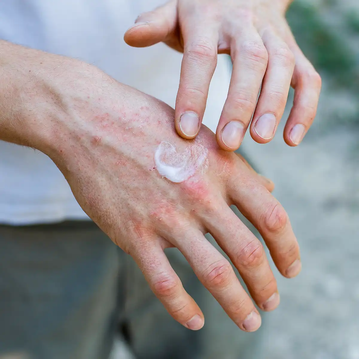 Combination Ointments