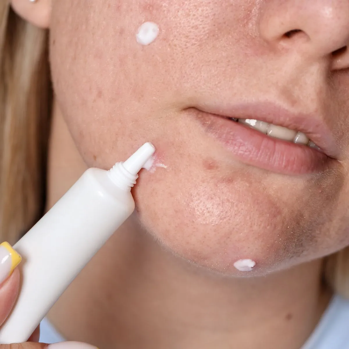 Post-Acne Scar Treatments