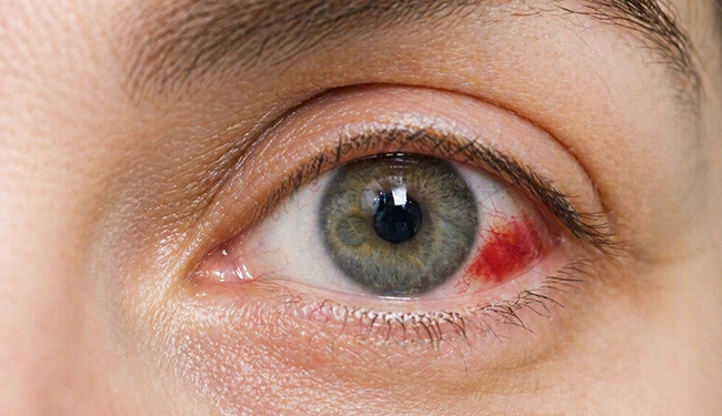 Ripasudil and Timolol combination therapy for Glaucoma
